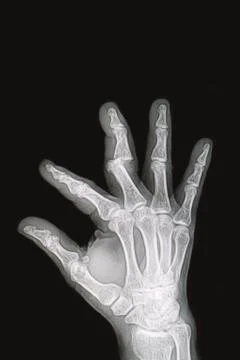 Wrist and hand  x-rays image show fracture and dislocation bone Stock Photos