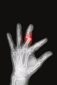 Wrist and hand  x-rays image show fracture and dislocation bone Stock Photos