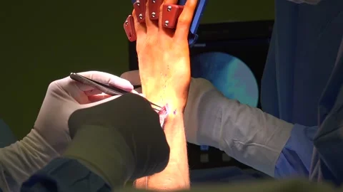 Wrist Arthroscopy or Triangular Fibrocartilage Disc surgery performed in ho.. Stock Footage 239620241