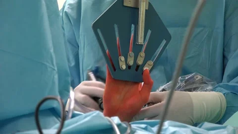 Wrist Arthroscopy or Triangular Fibrocartilage Disc Stock Footage 239775681