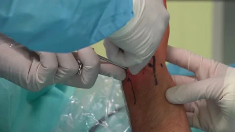 Wrist Arthroscopy or Triangular Fibrocartilage Disc in hospital Stock Footage 239775706