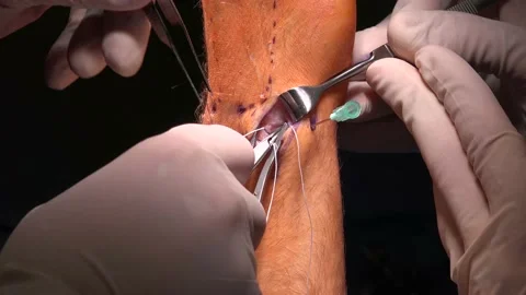 Wrist Arthroscopy or Triangular Fibrocartilage Disc surgery performed in pu.. Stock Footage 239775730