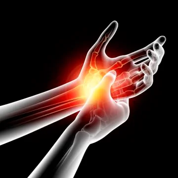 Wrist pain, artwork Stock Illustration