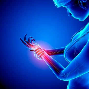 Wrist pain, artwork Stock Illustration