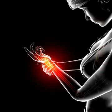 Wrist pain, artwork Stock Illustration