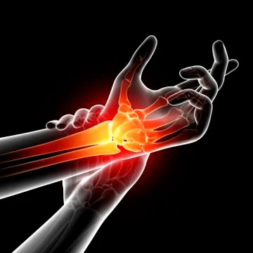 Wrist pain, artwork Stock Illustration