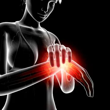 Wrist pain, artwork Stock Illustration