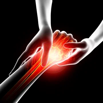 Wrist pain, artwork Stock Illustration