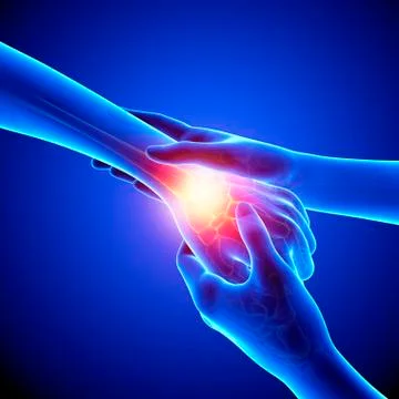 Wrist pain, artwork Stock Illustration