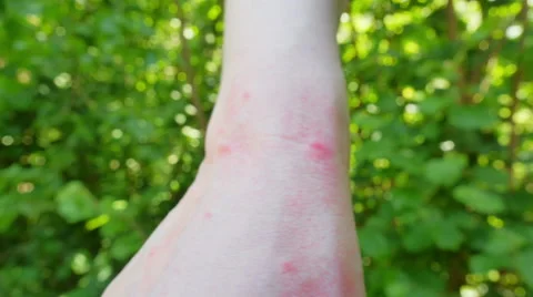 Wrist with several insect/ mosquito bites and scratch marks Stock Footage 51806785