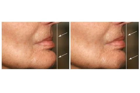 Wrong bite. Malocclusion. Lip profile. Correction of bite Stock Photos