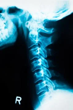 X-ray 1 Foto stock