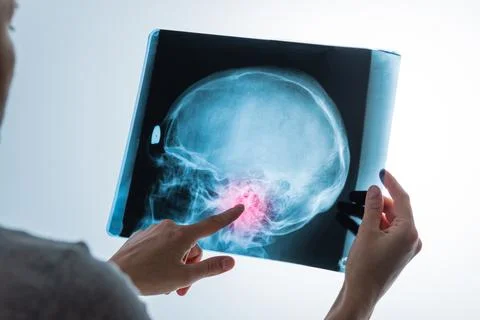 X-ray analysis of head skull image with red pain point in hands of specialist Foto stock