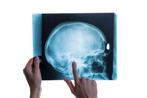 X-ray analysis of head skull image in hands of specialist Stock Photos