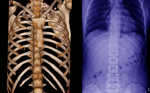 X-ray and CT Scan thoracic spine Stock Photos