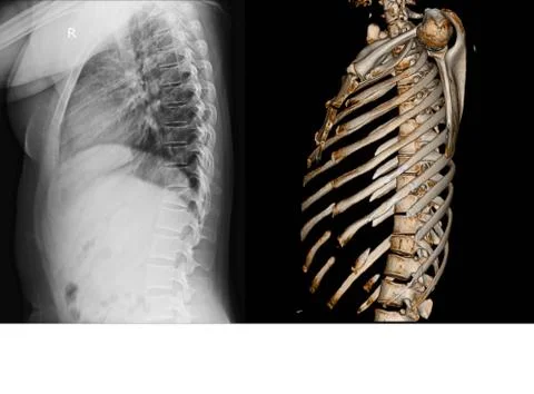 X-ray and CT Scan thoracic spine Stock Photos