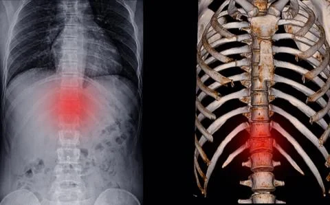 X-ray and CT Scan thoracic spine Stock Photos