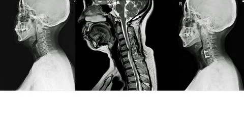 X-ray and MRI of cervical spine History of neck pain, radiate to arms, rule o Stock Photos