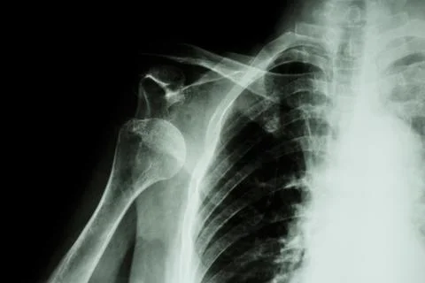 X-ray anterior shoulder dislocation Stock Photos