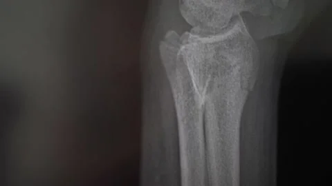 X-ray of the arm bone. Radiologist examines the crack Stock Footage 134937591