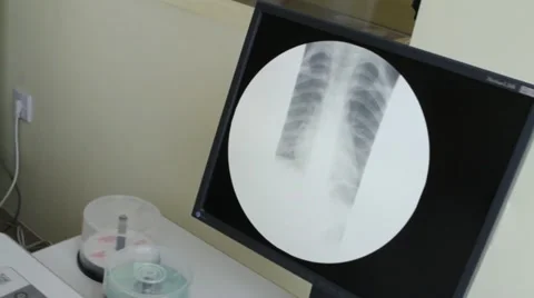 X-Ray body surgery Video stock 12552918
