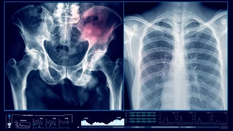 X-ray of bone cancer  Stock Footage 221028946