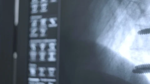 X-ray with bone fracture on a computer monitor 2 Stock Footage 101478517