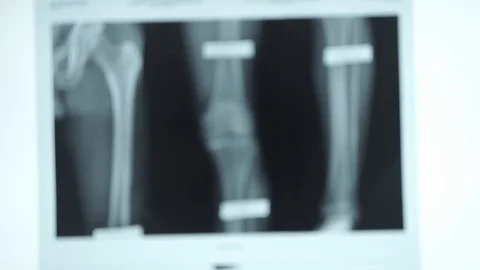 X-ray with bone fracture on a computer monitor Stock Footage 101478587