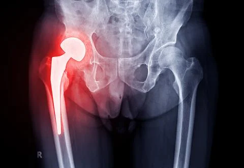 X-ray Both hip  ap view showing Right hip replacement or hip prosthesis mad.. 스톡 일러스트