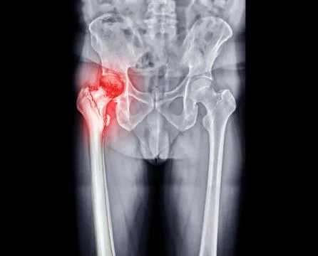 X-ray Both hip  ap view showing Right hip replacement or hip prosthesis mad.. Stock Illustration
