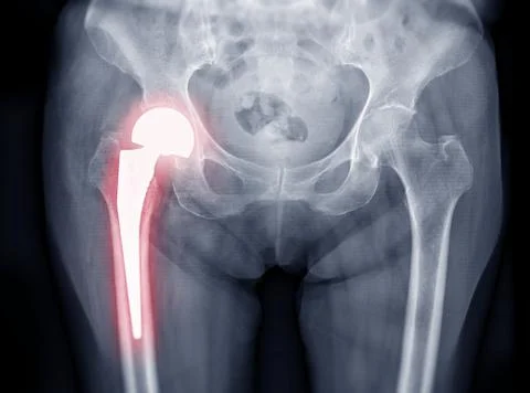 X-ray Both hip  ap view Stock Photos