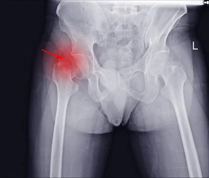 X-ray both hip (AP)finding fracture neck femur. Stock Photos