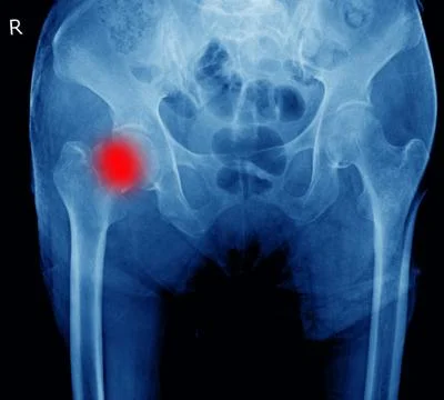 X-ray both hip fracture neck femoral. Stock Photos
