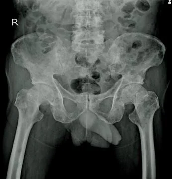 X-ray both Hip impression: Multiple bone metastasis. Stock Photos