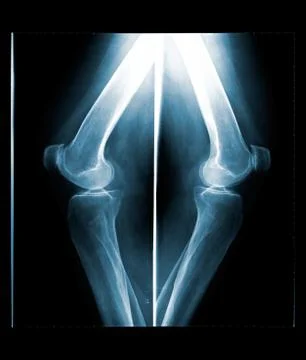 X-ray of both human knee. Stock Photos