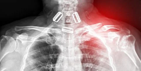X-ray of both shoulder joints, front view, showing a fracture of the left c.. Stock Illustration