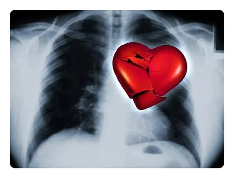 X-ray broken heart Stock Illustration