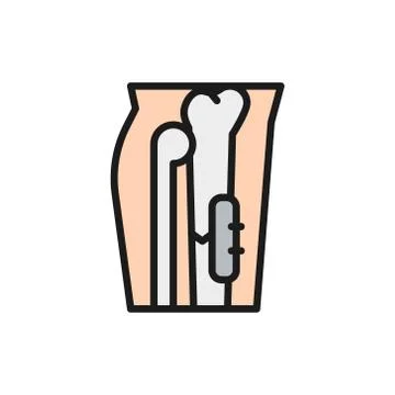 X-ray of broken leg, bone fixed with medical implantable plate flat color icon. Stock-Illustration