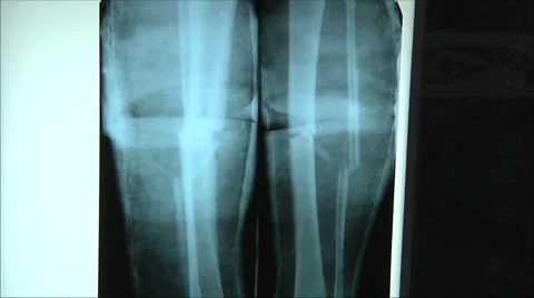 X-ray of broken legs Stock Footage 1011008