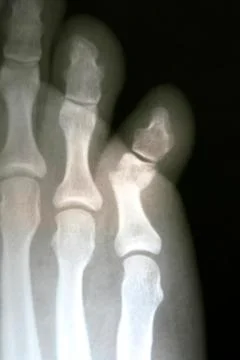 X-Ray of a broken toe Stock Photos