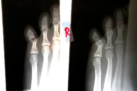 X-Ray of a broken toe 写真素材