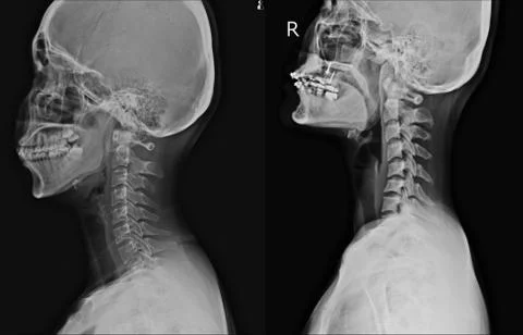 X-ray C-Spine 2 views Normal with Thoracic scoliosis with cervical spondylosi Stock Photos