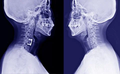 X-ray C-Spine Lateral normal views and Post operation spinal fixcation of C5- Stock Photos