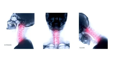 X-ray C-spine or x-ray image of Cervical spine Lateral extension ,AP and Flex Stock Illustration
