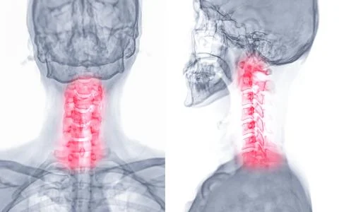 X-ray C-spine or x-ray image of Cervical spine AP and Lateral view for diag.. Stock-Illustration