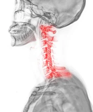 X-ray C-spine or x-ray image of Cervical spine lateral view for diagnostic .. Stock Illustration