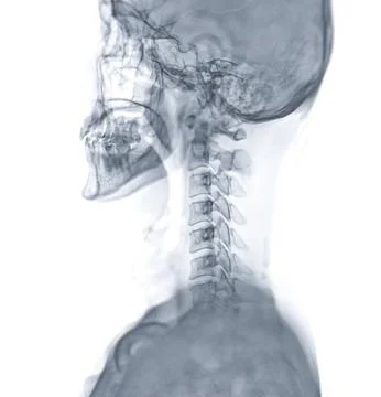 X-ray C-spine or x-ray image of Cervical spine lateral view for diagnostic .. 스톡 일러스트