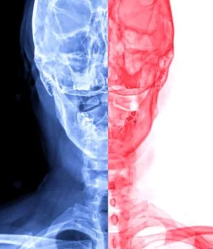 X-ray C-spine or x-ray image of Cervical spine open mount  view for  fractu.. Stock Illustration
