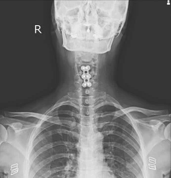 X-ray C-SPINES : AP,LATERAL Stock Photos