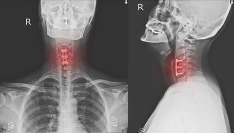 X-ray C-SPINES : AP,LATERAL Stock Photos